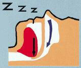 睡眠時無呼吸症候群（いびき症）